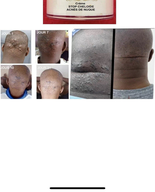 SUPER CRÈME REPARATRICE  STOP CHÉLOÏDE ACNÉS DE NUQUE LES BOUTONS APRÈS  RASAGE
