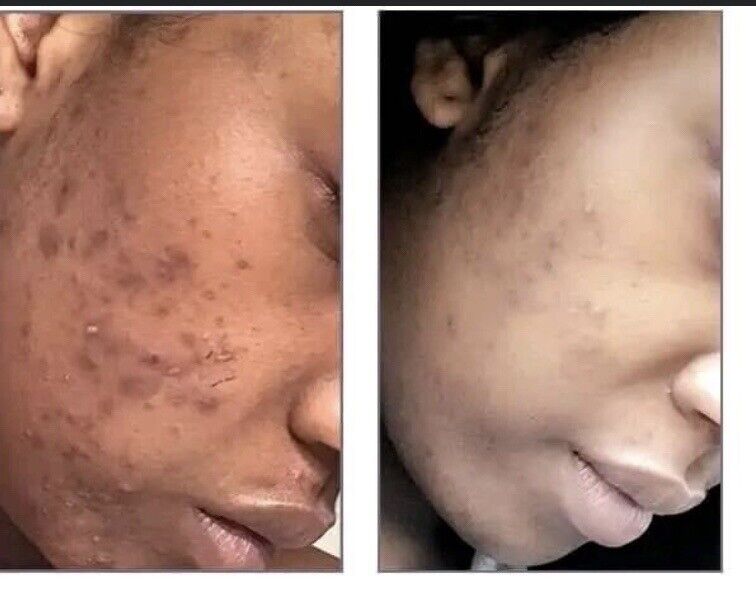 Blanchisseur Total Megane White Serum  à  l’acide Kojic, Carotène Vitamine E