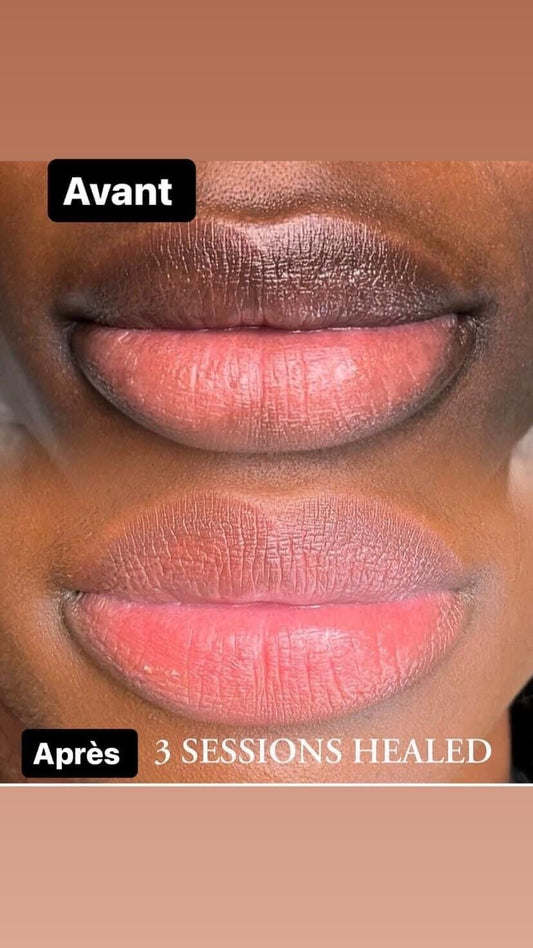 Crème Lèvres Rose, Levres Foncées Résultat 7 Jours - Kyabeauty